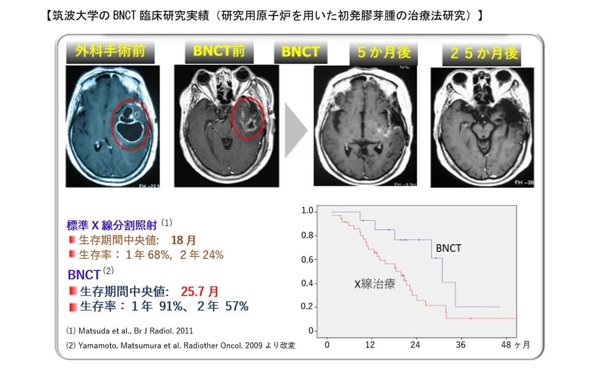 筑波大学BNCT临床研究成果（利用研究型核反应堆研究新诊断胶质母细胞瘤的治疗方法）