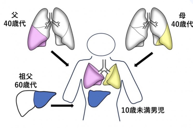 男童同時接受雙親及祖父所捐出的部分肺與肝移植。京都大學醫學部附屬醫院圖片